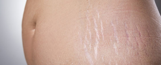 Smagliature e cicatrici